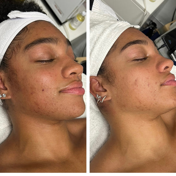 10% Glycolic Acid Exfoliating Pads Gleaux Aesthetics Skincare