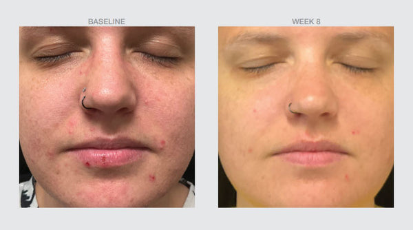 Blemish Control Serum