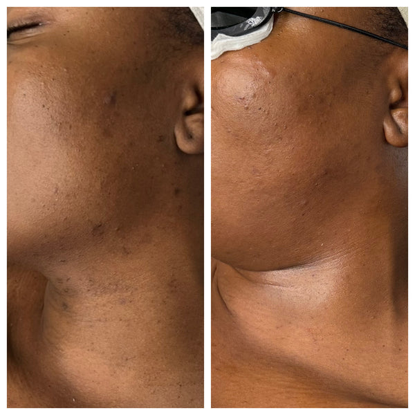 10% Glycolic Acid Treatment Cleanser Gleaux Aesthetics Skincare