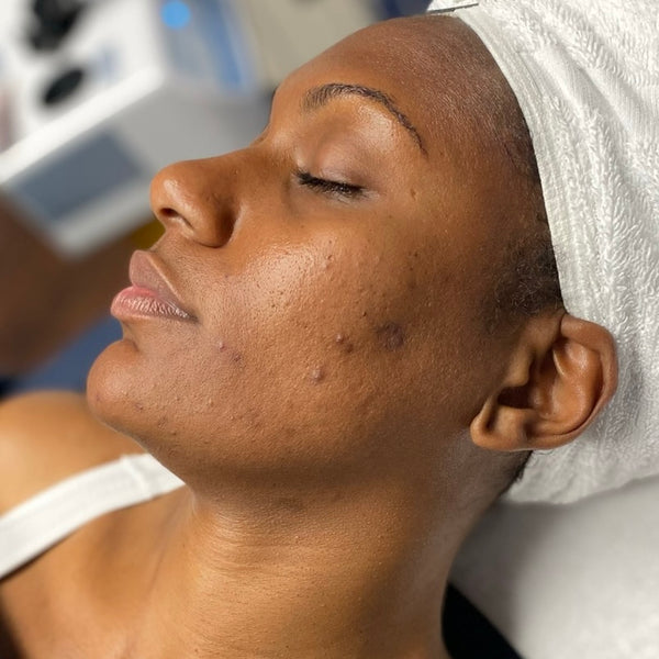 Acne Spot Treatment Gleaux Aesthetics Skincare