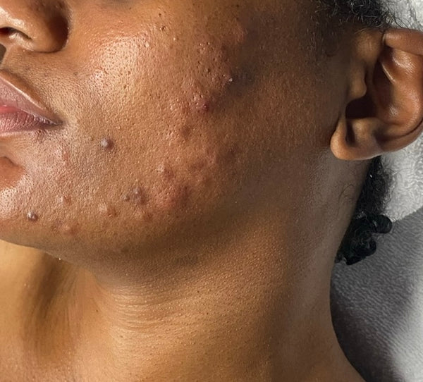 Acne Spot Treatment Gleaux Aesthetics Skincare